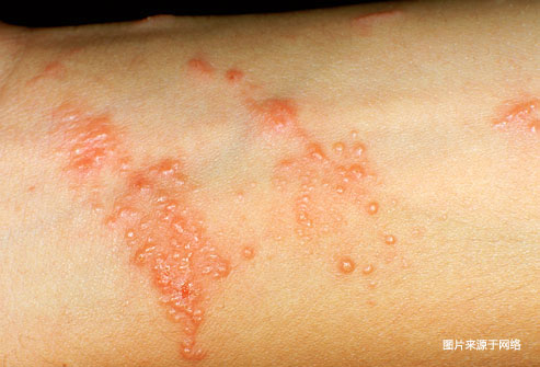 碰触有毒植物后怎么办